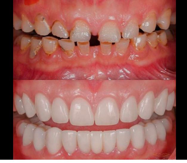 Servicio de dentaduras totales